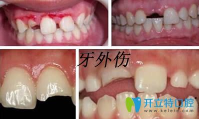 口腔知識(shí):牙外傷處理原則以及兒童牙齒外傷脫位的應(yīng)急處理