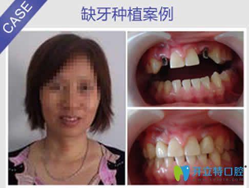 重慶華諾世口腔李清種植牙真人案例效果