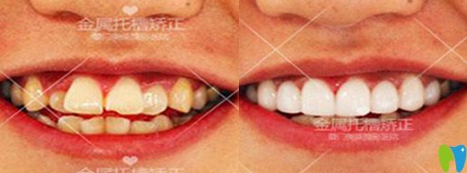 <!--<i data=20240703-sp></i>-->美萊口腔靠譜嗎？真人案例效果來(lái)驗(yàn)證實(shí)力