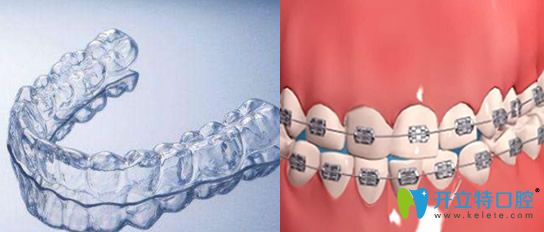 隱形透明牙套和鋼絲牙套哪個(gè)好?隱形牙套和鋼牙套區(qū)別對(duì)比