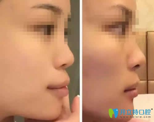 看妹子在南昌輝煌口腔做隱形齙牙矯正前后臉型對(duì)比照片 