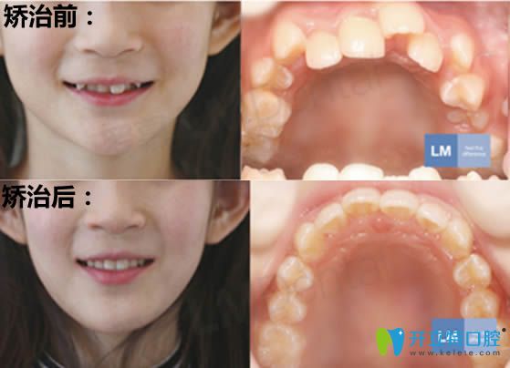 兒童牙齒擁擠早期矯正前后對比效果