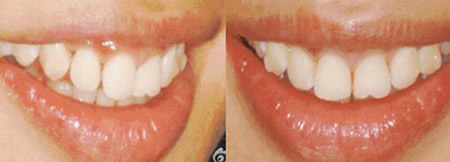 記錄我在上海美萊口腔戴第50副隱形牙套的經(jīng)歷 正畸進行中