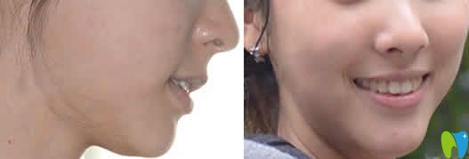 我在海口國雅口腔做隱形牙齒矯正2年后照片