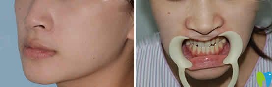 這是兩年前我在南昌安植雅口腔做地包天牙齒矯正真實案例