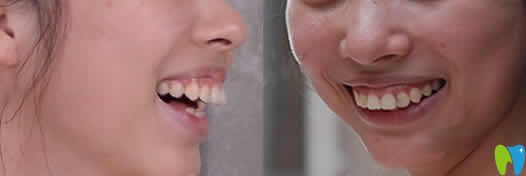 我在海口國雅口腔做隱形牙齒矯正前后照片及親身經歷分享