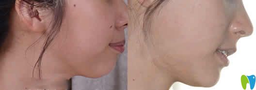 我在?？趪趴谇蛔鲅例X矯正前后對比照片