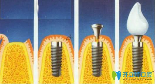 種植牙過程分為幾個(gè)步驟