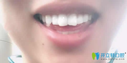 我在天津德倍爾口腔做即刻種植牙后的照片 我在天津德倍爾口腔做即刻種植牙后的照片