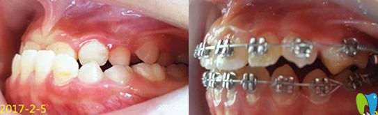屬于瑾帆口腔的10歲女童地包天矯正案例
