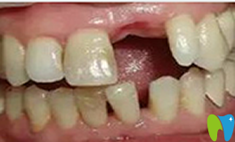 種植牙不好嗎？談?wù)勎野衷谖錆h華美口腔種植牙感受