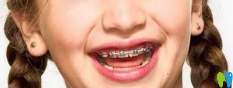 <!--<i data=20240703-sp></i>-->南醫(yī)生解析兒童牙齒矯正的年齡 <!--<i data=20240703-sp></i>-->南醫(yī)生解析兒童牙齒矯正的年齡