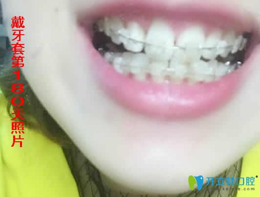 我在合肥世佳口腔做陶瓷托槽矯正180天照片