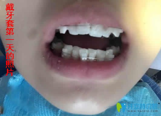 公布我牙齒擁擠在合肥世佳口腔做陶瓷托槽矯正前后對比照