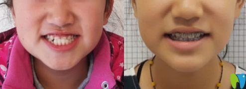 周瑾帆替牙期小孩地包天矯正案例前后效果對(duì)比圖