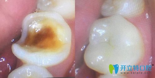 周瑾帆后牙嵌體修復(fù)牙齒案例