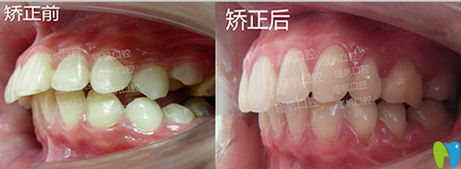 桂林瑾帆口腔好不好？真人牙齒矯正案例及術(shù)后反饋來驗證