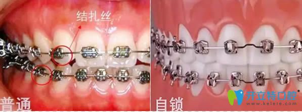 普通牙套和自鎖牙套哪個(gè)好?請(qǐng)看自鎖和傳統(tǒng)牙套區(qū)別及價(jià)格