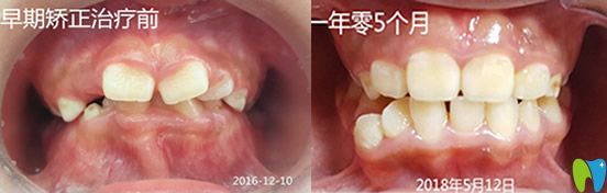 想了解孩子牙齒矯正時間 看桂林瑾帆口腔兒童正畸案例