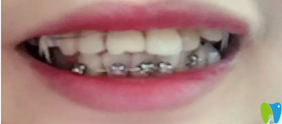 在武漢斯美爾口腔矯正天