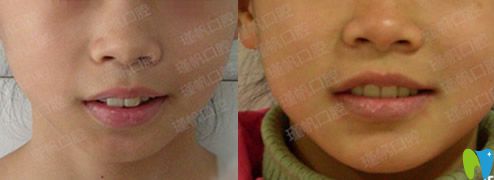 瑾帆口腔周瑾帆小孩門(mén)牙前突矯正案例