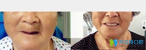 中山維爾口腔All-on-4全口種植牙真實案例