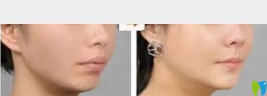 中山維爾口腔齙牙矯正后臉型對比圖