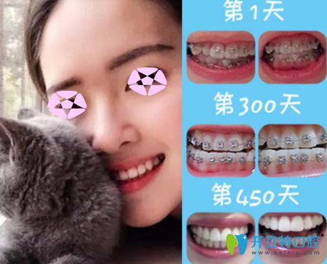 成人矯正牙齒效果好嗎？看上海伊爾意口腔正畸前后對(duì)比圖