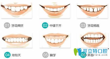 適合隱形牙齒矯正的三大癥狀