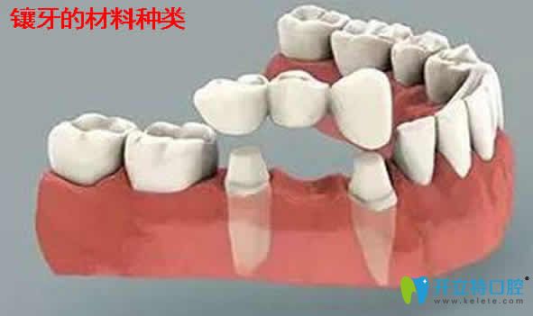 全面介紹鑲牙多少錢(qián)一顆及能用醫(yī)保嗎？