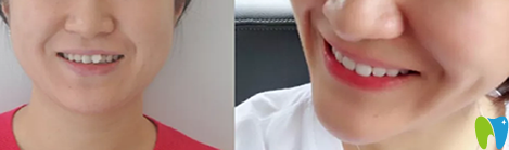 在優(yōu)植口腔牙齒矯正對比圖 在優(yōu)植口腔牙齒矯正對比圖