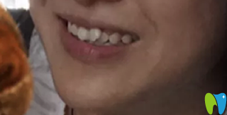 長沙優(yōu)植口腔牙齒矯正前 長沙優(yōu)植口腔牙齒矯正前