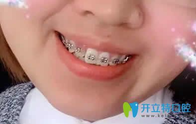 我在寧波恒美口腔做牙齒矯正第3個月照片