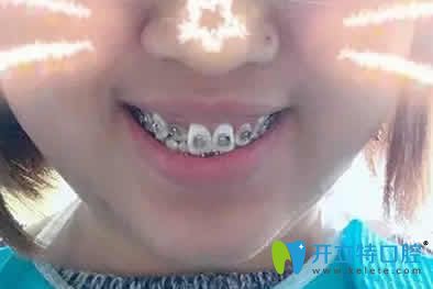 我在寧波恒美口腔做自鎖托槽牙齒矯正第3個月照片