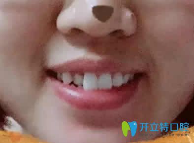 我在寧波恒美口腔做兔牙矯正后臉型變好看了 附前后對比照