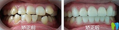 誠(chéng)之康口腔兒童矯正效果圖
