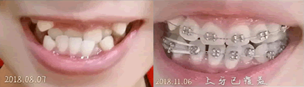 講述我在北京誠之康口腔做牙齒矯正,附3個(gè)月矯正過程變化圖