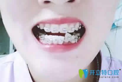 我在太原皓久口腔做金屬托槽牙齒矯正第9個(gè)月照片 我在太原皓久口腔做金屬托槽牙齒矯正第9個(gè)月照片