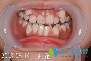 我在誠(chéng)之康口腔矯正前照片