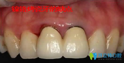 鎳鉻烤瓷牙的優(yōu)缺點(diǎn)