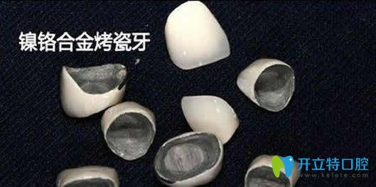 鎳鉻烤瓷牙的副作用