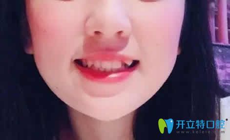 透露我在廈門天使口腔做虎牙矯正前后對比照片及親身經(jīng)歷