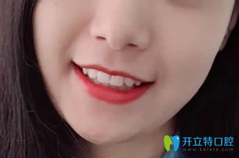 我在廈門天使口腔做牙齒矯正18個月照片