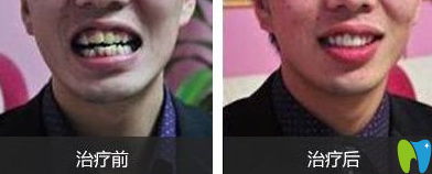 誠之康口腔怎么樣？真人矯正效果圖