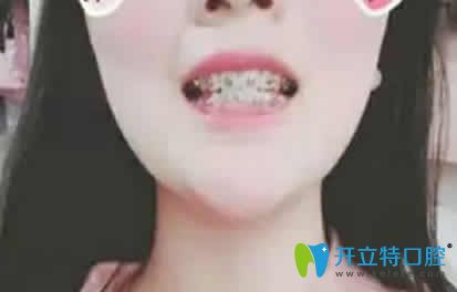 我在太原皓久口腔做牙齒矯正戴牙套第3個(gè)月照片 我在太原皓久口腔做牙齒矯正戴牙套第3個(gè)月照片