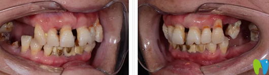 去鄭州未來(lái)口腔做牙齒種植前側(cè)面口腔照片