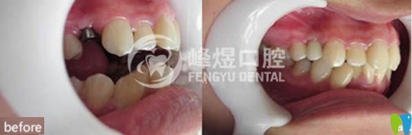 單顆牙缺失種植案例及對(duì)比效果圖