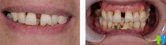 在鄭州未來(lái)口腔種植牙前