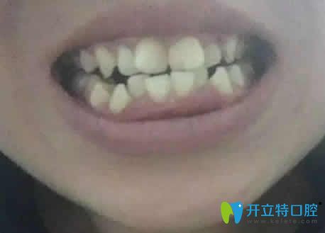 廣州偉聯(lián)口腔牙齒正畸怎么樣 金屬自鎖托槽矯正效果來(lái)揭曉