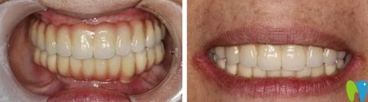 找鄭州美萊口腔歐陽(yáng)秋玲做牙齒種植后圖